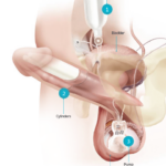 inflatable penile prosthesis