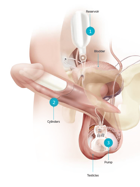 inflatable penile prosthesis