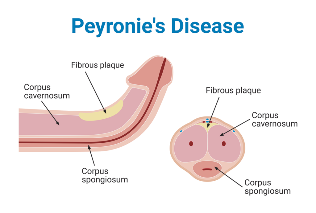 Peyronie's Disease